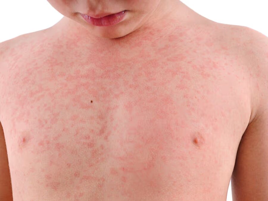 Após caso de meningite no Acre, Sena Madureira intensifica vacinação nas unidades de saúde
