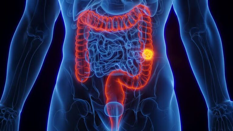 Exame de rastreamento do câncer de intestino.