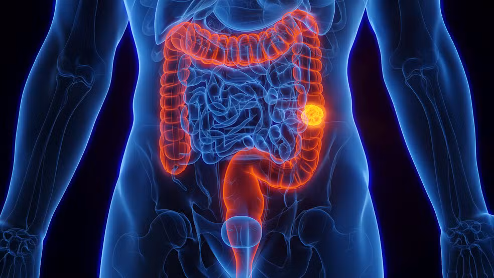 Exame de rastreamento do câncer de intestino.