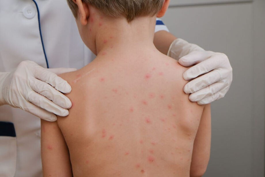 Em Cruzeiro do Sul após confirmação de caso de meningite bacteriana em estudante.