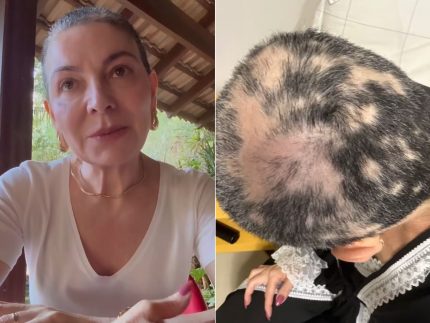 Após melhora, mãe de Lucas Lucco lamenta recaída de alopecia severa: “Mais triste”