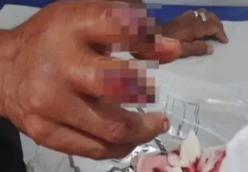 Trabalhador rural sofre grave acidente com máquina de mandioca em Sena Madureira