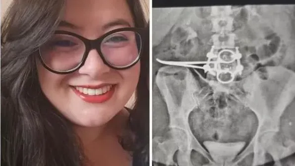 Tesoura cirúrgica é esquecida em abdômen de paciente após cirurgia em São Paulo.