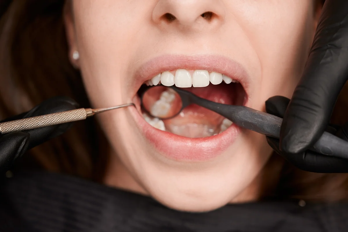 Cientistas criam gel que pode regenerar dentes deteriorados pela cárie