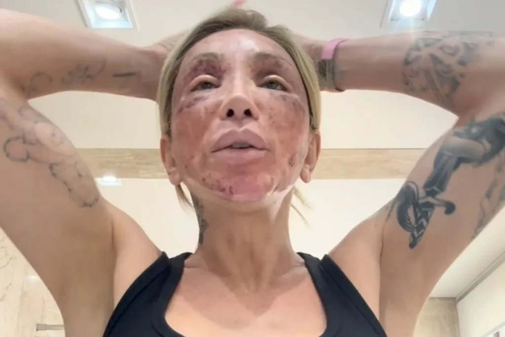 Especialistas explicam ferimentos de Maya Massafera após tratamento