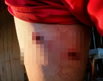 Morador do Rio Macauã é baleado acidentalmente por armadilha de caça.