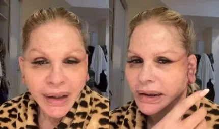Monique Evans revela perrengue com banco após cirurgia facial: “Não me reconheceram”