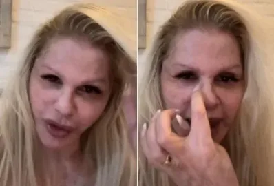 Monique Evans mostra rosto sete dias após cirurgia plástica: “Estou apaixonada”