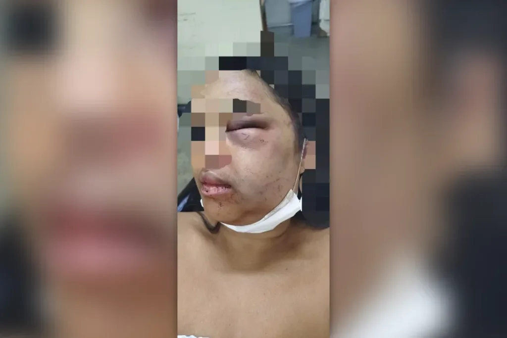 Mulher denuncia ex após ter maxilar quebrado e ficar com rosto deformado
