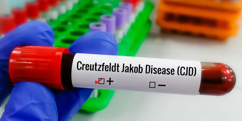 Entenda Doença de Creutzfeldt-Jakob e busca por tratamento