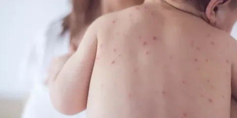 Estado de São Paulo reforça necessidade de vacinação contra o sarampo