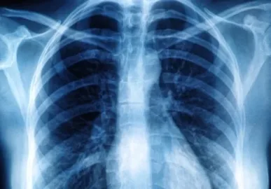 Medica do Acre celebra aprovacao de tratamento inedito contra fibrose pulmonar.