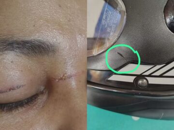 Diarista sofre cortes por linha de pipa em Rio Branco.