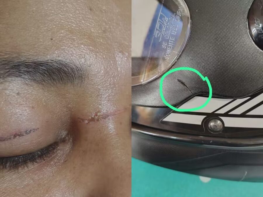 Diarista sofre cortes por linha de pipa em Rio Branco e diz: “Nasci de novo”