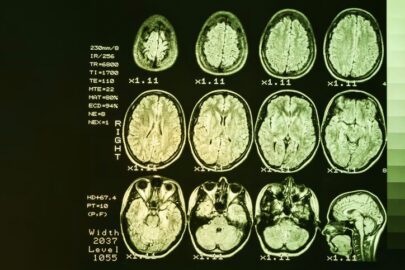 Cuidadora acompanha paciente em tratamento para condição neurodegenerativa