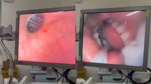 Bateria tipo botão de lítio sobre bandeja médica em hospital.