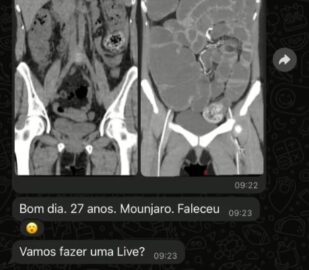 Profissional de saúde analisando exame de imagem em ambiente hospitalar para diagnosticar complicação intestinal grave.